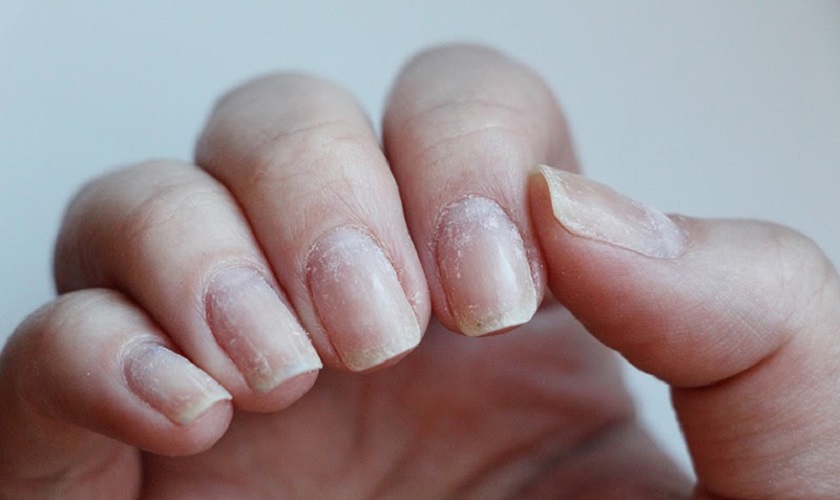 Что происходит с ногтями после гель-лака