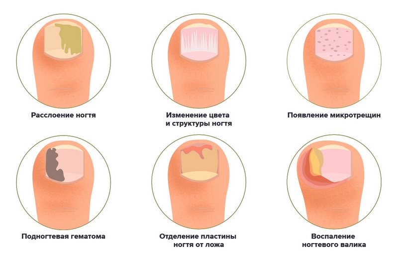 Причины огрубения ногтей на ногах